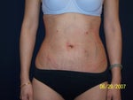1 day after Smartlipo