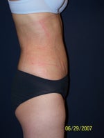 1 day after Smartlipo