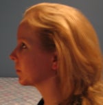 After chin augmentation