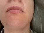 Biggest scar above upper lip on the right