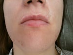Biggest scar above upper lip on the right