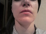 Biggest scar above upper lip on the right