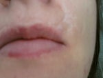 Biggest scar above lip on the right