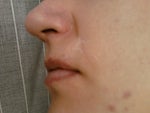 Biggest scar above upper lip on the right