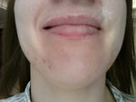 Biggest scar above upper lip on the right