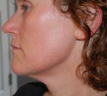 left side - 1 year later