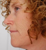 left side - before