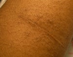 large lipoma removed from forearm