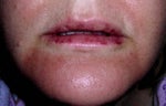 lips after Juvederm treatment