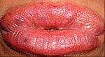 4hr after juvederm