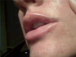 some bruising in the corners of mouth