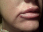 more bruising on lower corner