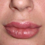 One day post injection. swelling in upper left, lower right and top middle. 