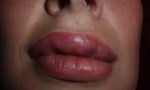 restylane lips up close
