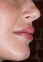 restylane lips profile