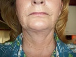 Lower right side of face is loose and fuller. Dr. only willing to lipo to reduce fullness