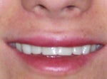 after..no make-up..new teeth (well not the permanent ones)