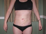 after (day of surgery)