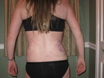 after (day of surgery)
