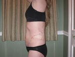 after (day of surgery - still really swollen)