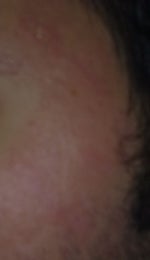 Left side 10 days  after fraxel very bad redness and not heal places 