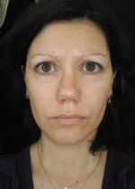 3 months after rhinoplasty. Twisted, retracted columella.
