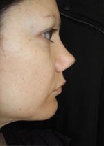 profile after rhinoplasty (no columella, excessive turn up)