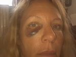 This was the black eye a day after the procedure. The bagginess came on a few days later.