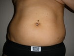 Day Before Surgery