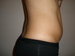 Day Before Surgery