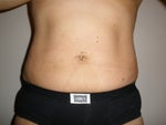 1 Week Post-op