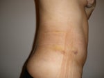 1 Week Post-op