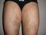 1 Week Post-op
