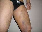 1 Week Post-op bruising