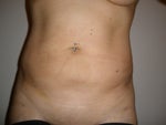 1 Week Post-Op