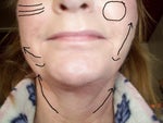 Left side of face pulled too much. Right side of face still hanging