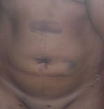 day 5 post op (ouch!) 