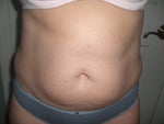Pre-op