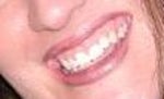 Before veneers and laser gum recontouring