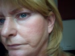 This is a much better picture of the sweep mark.  I only have this on the left side of my face.  