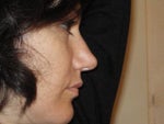 BEFORE  rhinoplasty profile (much BETTER!!)