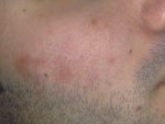 Spot befor fraxel my face 