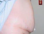 Before surgery picture