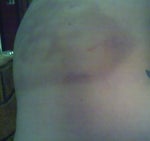 day 3 after my third treatment (side view)
