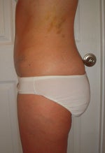 10 days post sugery, bruising from lipo, but feel great!