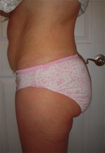 Before surgery
