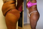 side view 2 days before and 1 day post op