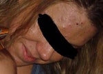 Before Accutane