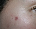 Burn from age spot treatment