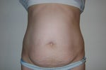 Before surgery